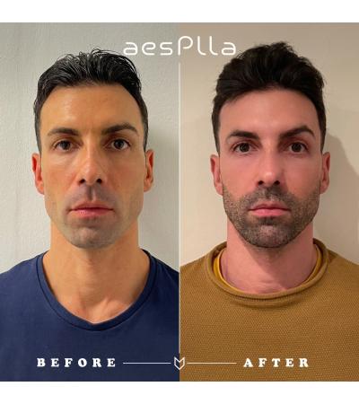 Aesplla 365 mg PLLA Collagen Biostimulator